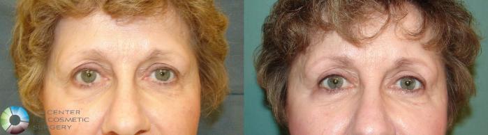 Before & After Eyelid Lift Case 612 View #1 View in Golden, CO