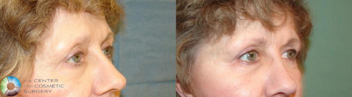 Before & After Eyelid Lift Case 612 View #2 View in Golden, CO