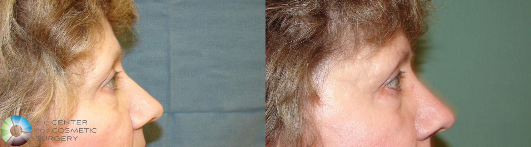 Before & After Eyelid Lift Case 612 View #3 in Denver and Colorado Springs, CO