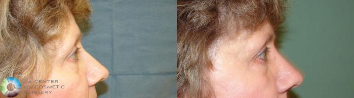 Before & After Eyelid Lift Case 612 View #3 View in Golden, CO