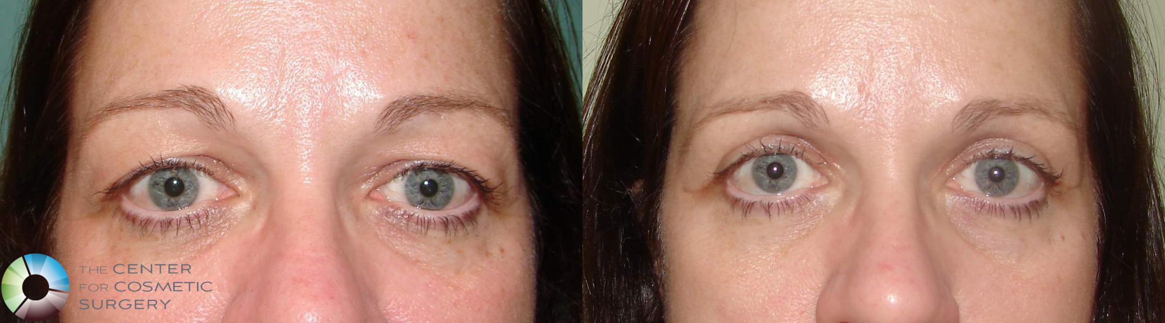 Eyelid Lift Case 613 Before & After View #1 | Golden, CO | The Center for Cosmetic Surgery