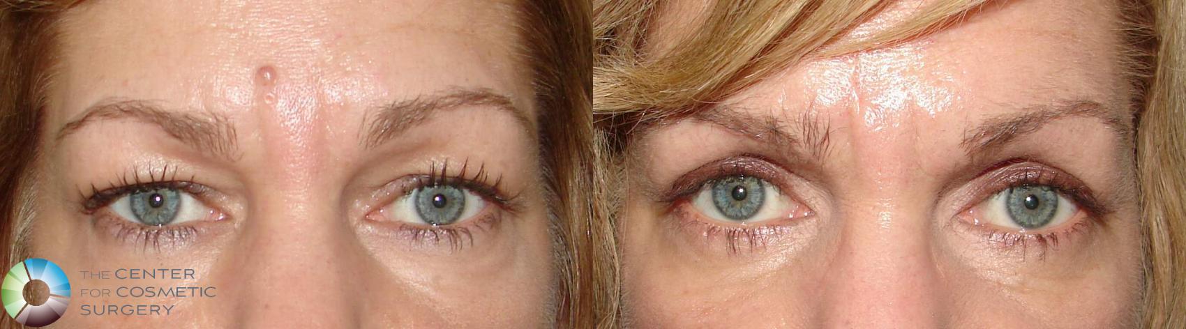 Before & After Eyelid Lift Case 632 View #1 in Denver, CO