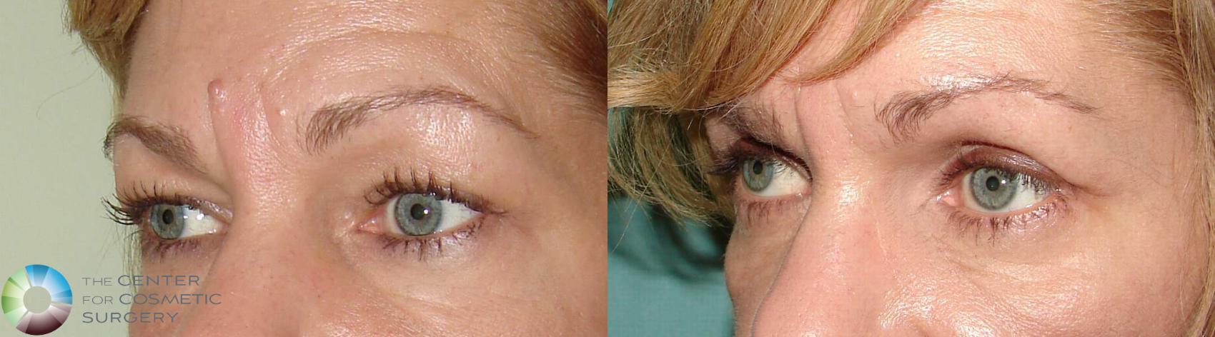 Before & After Eyelid Lift Case 632 View #2 View in Golden, CO