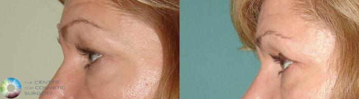 Before & After Eyelid Lift Case 632 View #3 View in Golden, CO