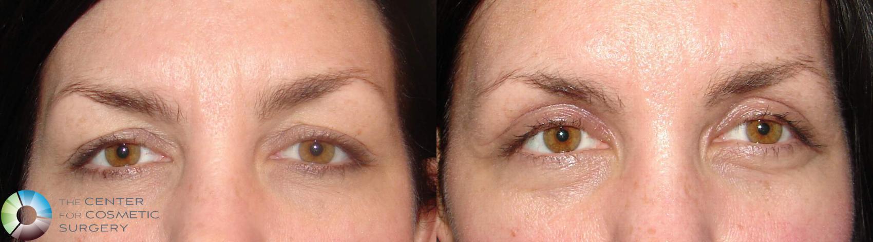 Before & After Eyelid Lift Case 633 View #1 in Denver, CO