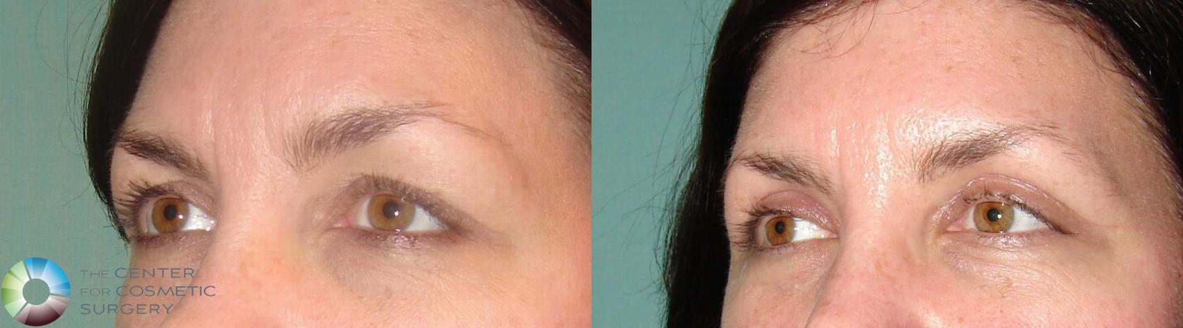 Before & After Eyelid Lift Case 633 View #2 in Denver and Colorado Springs, CO