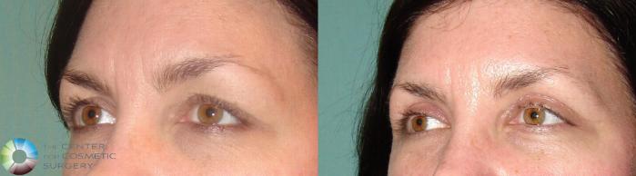 Before & After Eyelid Lift Case 633 View #2 View in Golden, CO