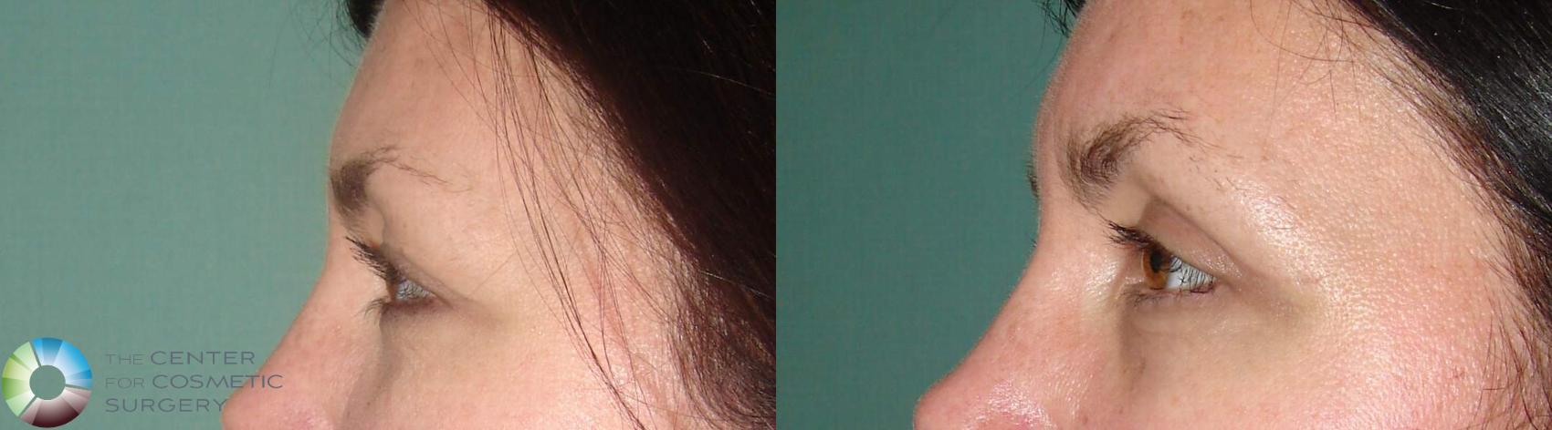 Before & After Eyelid Lift Case 633 View #3 in Denver and Colorado Springs, CO