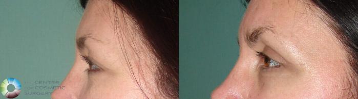 Before & After Eyelid Lift Case 633 View #3 View in Golden, CO