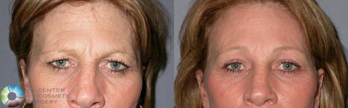 Before & After Eyelid Lift Case 66 View #1 View in Golden, CO