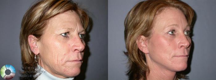 Before & After Eyelid Lift Case 66 View #3 View in Golden, CO