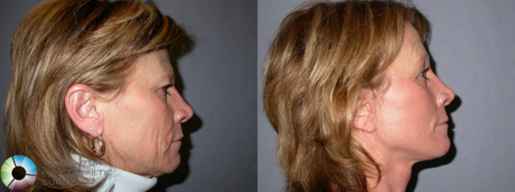Before & After Eyelid Lift Case 66 View #4 View in Golden, CO