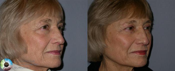 Before & After Eyelid Lift Case 70 View #1 View in Golden, CO