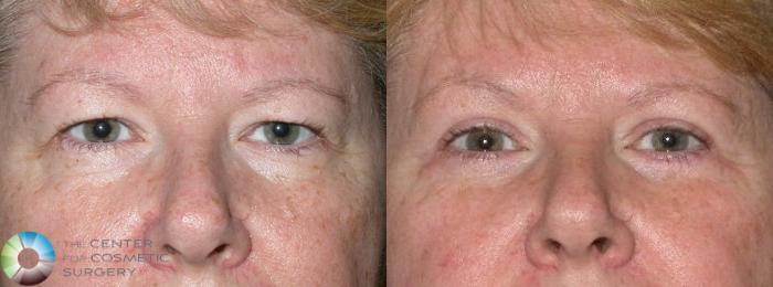 Before & After Eyelid Lift Case 71 View #1 View in Golden, CO