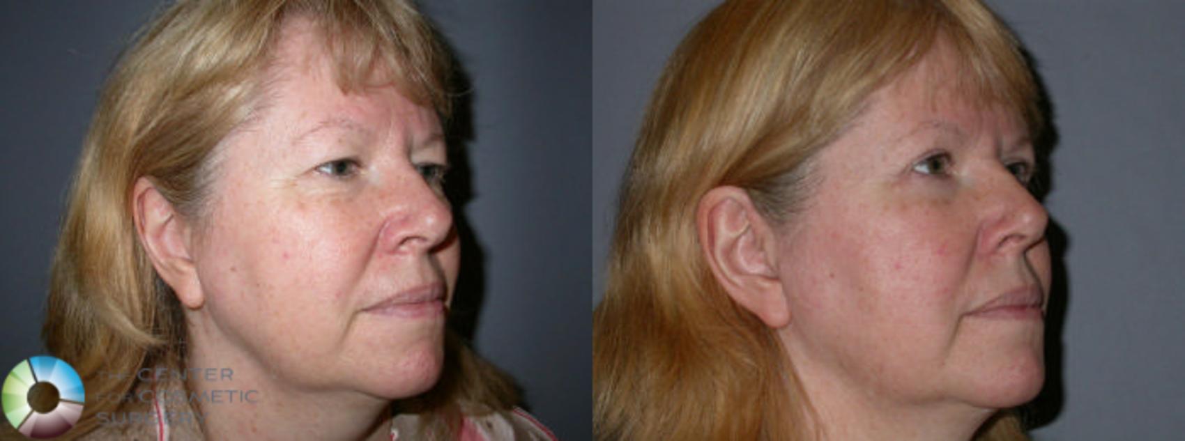 Before & After Eyelid Lift Case 71 View #2 in Denver and Colorado Springs, CO