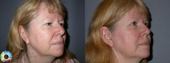 Before & After Eyelid Lift Case 71 View #2 View in Golden, CO
