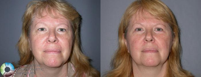 Before & After Eyelid Lift Case 71 View #3 View in Golden, CO