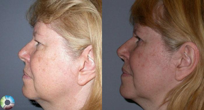 Before & After Eyelid Lift Case 71 View #4 View in Golden, CO