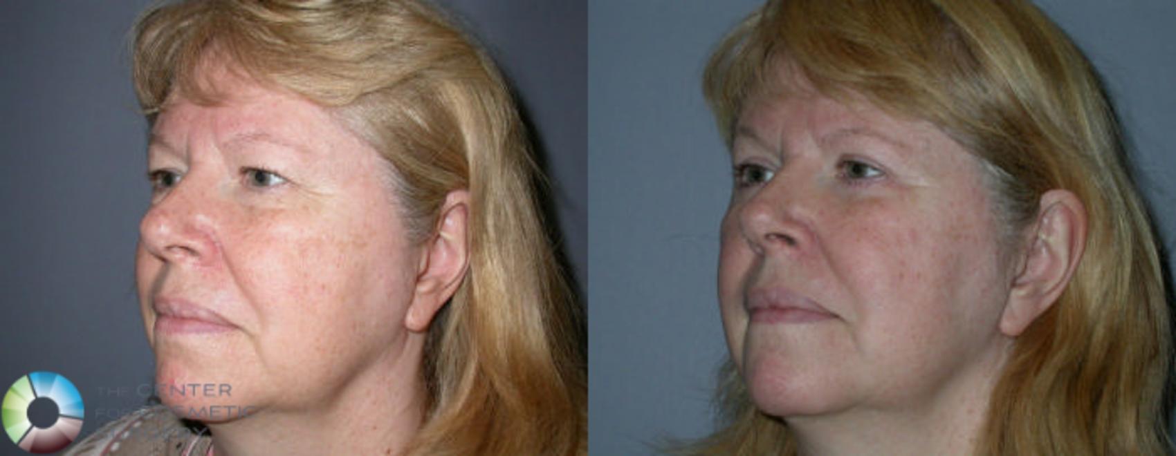 Before & After Eyelid Lift Case 71 View #5 in Denver and Colorado Springs, CO