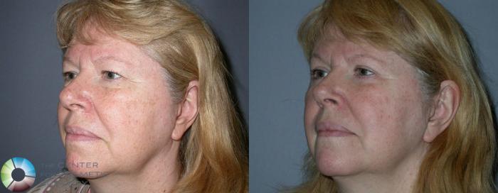 Before & After Eyelid Lift Case 71 View #5 View in Golden, CO