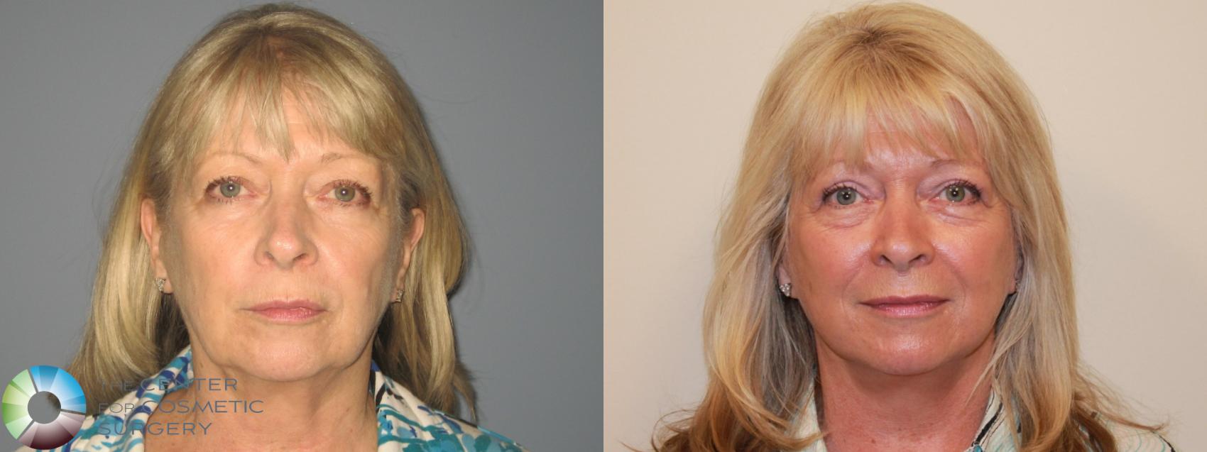 Before & After Eyelid Lift Case 719 View #1 View in Golden, CO