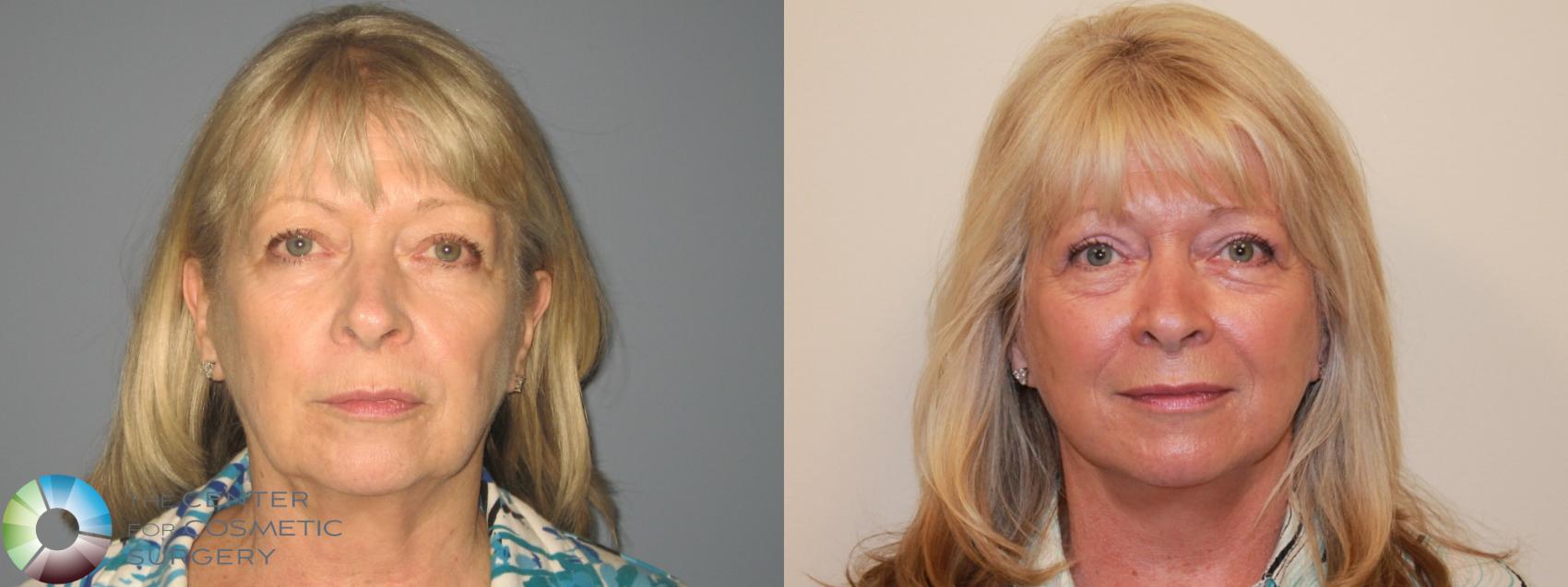 Before & After Mini Facelift Case 719 View #1 in Denver and Colorado Springs, CO