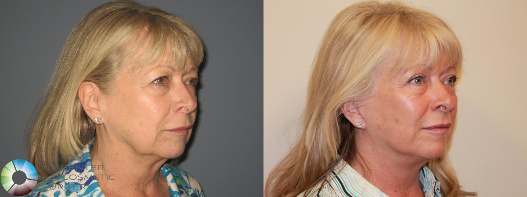 Before & After Eyelid Lift Case 719 View #2 View in Denver & Golden, CO