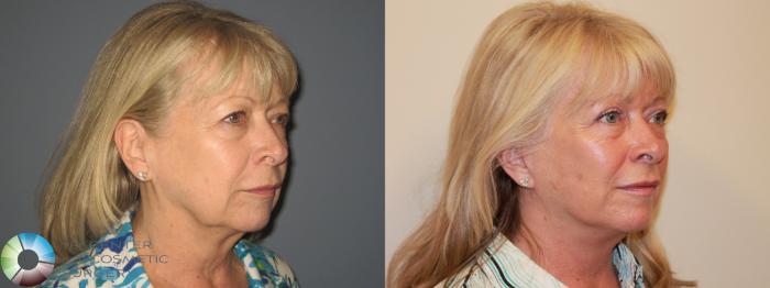Before & After Eyelid Lift Case 719 View #2 View in Golden, CO