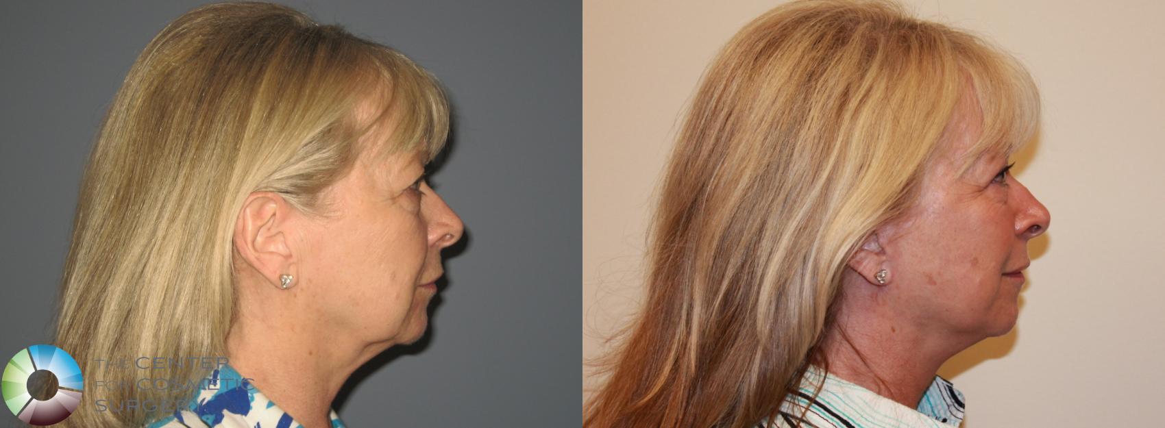 Before & After Eyelid Lift Case 719 View #3 View in Denver & Golden, CO