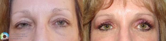 Before & After Eyelid Lift Case 838 View #1 in Denver and Colorado Springs, CO