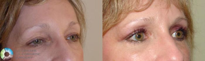 Before & After Eyelid Lift Case 838 View #2 in Denver and Colorado Springs, CO