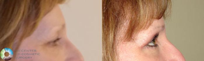 Before & After Eyelid Lift Case 838 View #3 in Denver and Colorado Springs, CO