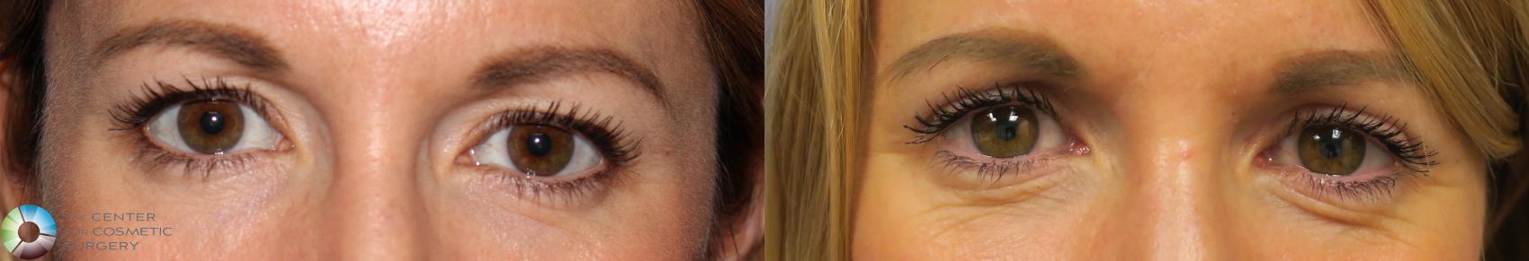 Before & After Eyelid Lift Case 887 View #1 View in Golden, CO