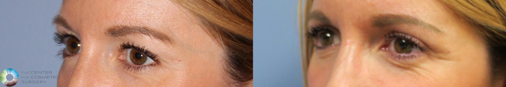 Before & After Eyelid Lift Case 887 View #2 in Denver and Colorado Springs, CO