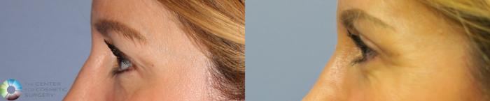 Before & After Eyelid Lift Case 887 View #3 View in Golden, CO