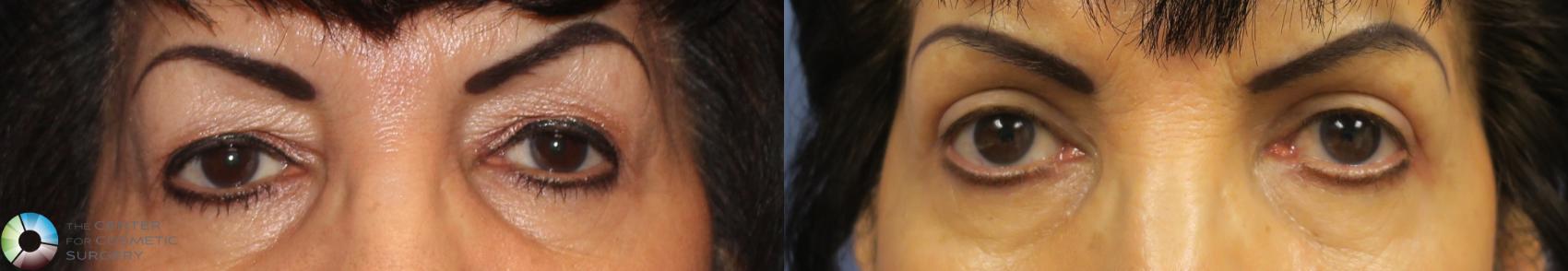 Before & After Eyelid Lift Case 888 View #1 in Denver and Colorado Springs, CO