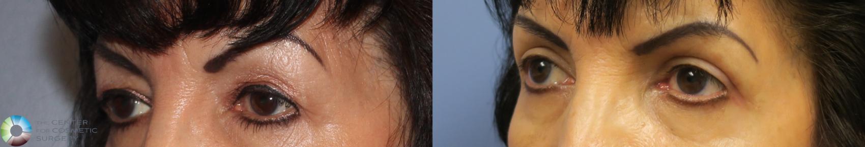 Before & After Eyelid Lift Case 888 View #2 View in Denver & Golden, CO