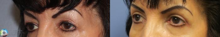 Before & After Eyelid Lift Case 888 View #2 View in Golden, CO