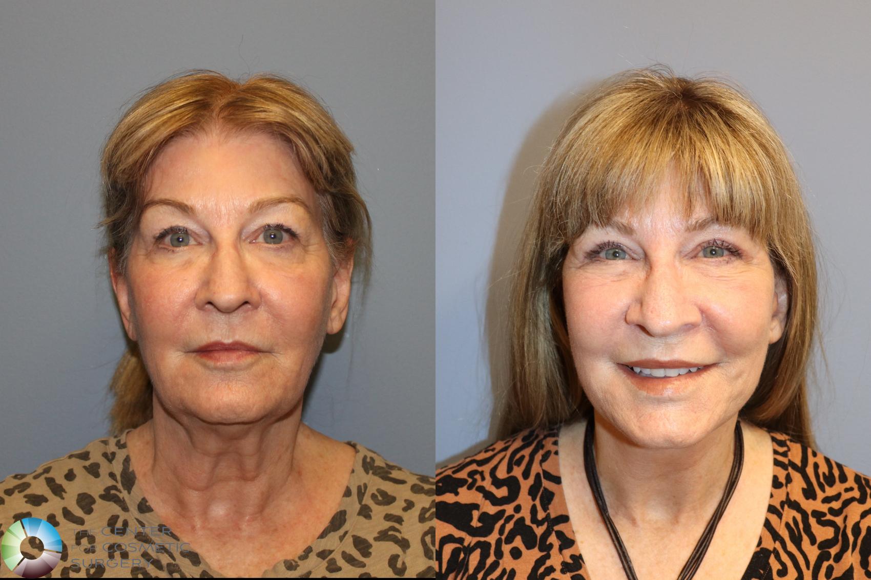 Before & After Eyelid Lift Case 12019 Front in Denver and Colorado Springs, CO