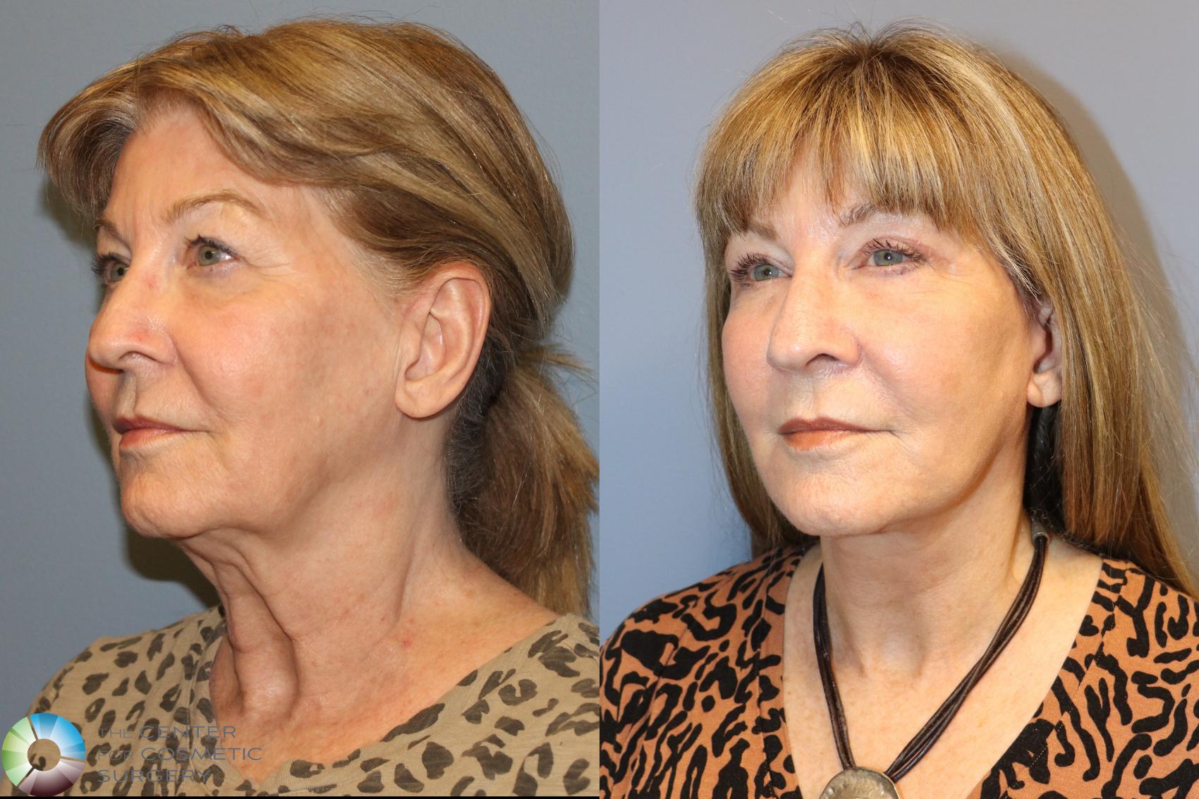 Before & After SMAS Facelift Case 12019 Left Oblique in Denver and Colorado Springs, CO
