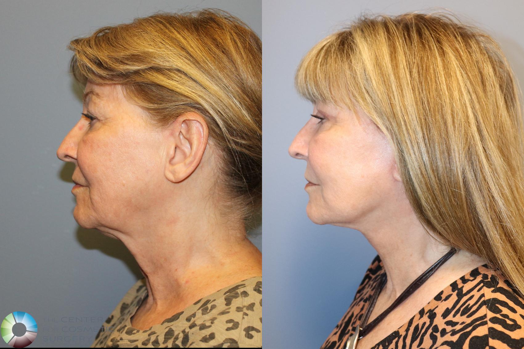 Before & After SMAS Facelift Case 12019 Left Side in Denver and Colorado Springs, CO