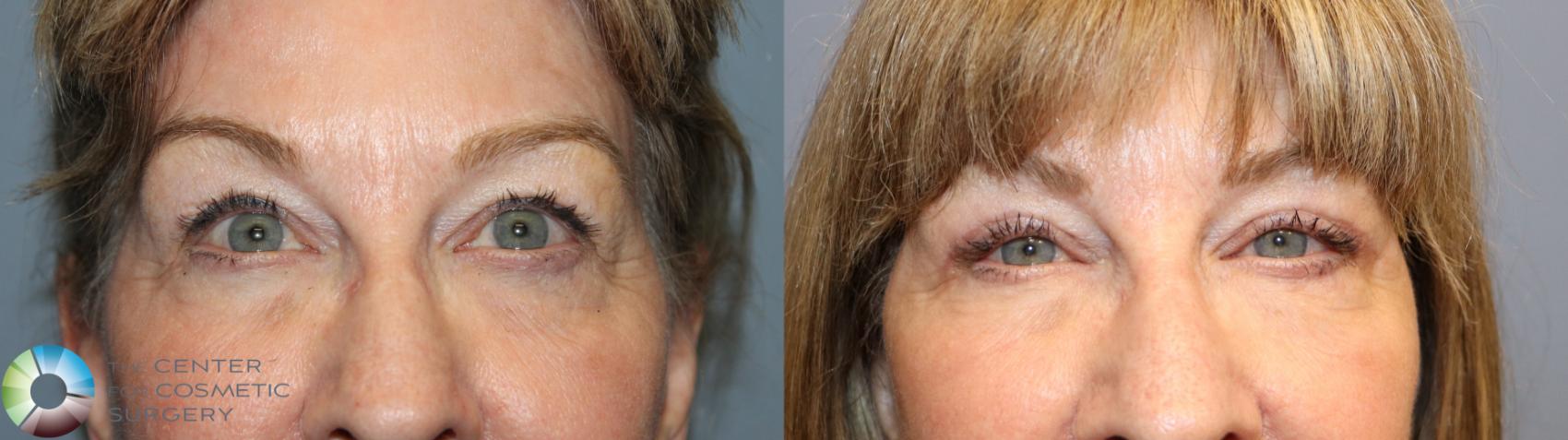 Before & After SMAS Facelift Case 12019 Upper Lids in Denver and Colorado Springs, CO