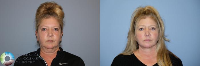 Before & After SMAS Facelift Case 12190 Front in Denver and Colorado Springs, CO