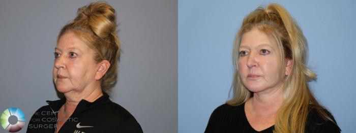 Before & After SMAS Facelift Case 12190 Left Oblique in Denver and Colorado Springs, CO