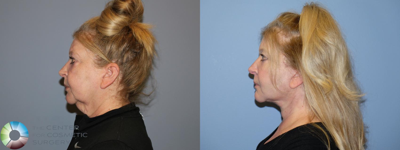 Before & After SMAS Facelift Case 12190 Left Side in Denver and Colorado Springs, CO
