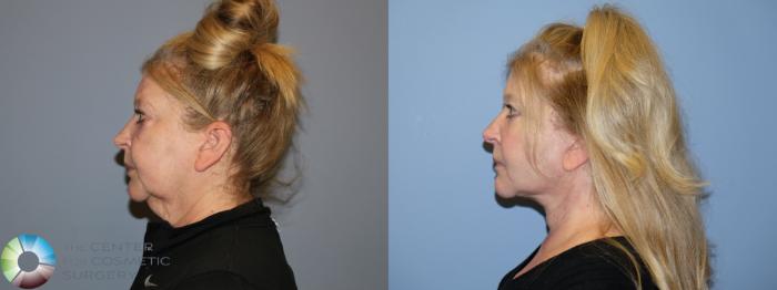 Before & After SMAS Facelift Case 12190 Left Side in Denver and Colorado Springs, CO