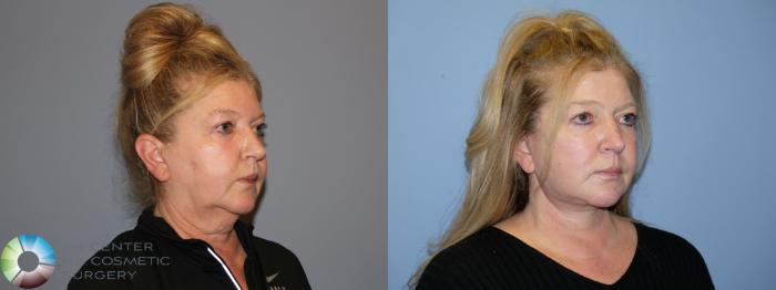 Before & After SMAS Facelift Case 12190 Right Oblique in Denver and Colorado Springs, CO