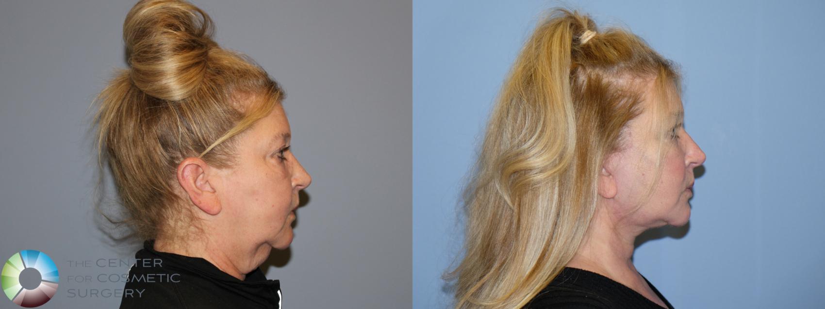 Before & After SMAS Facelift Case 12190 Right Side in Denver and Colorado Springs, CO