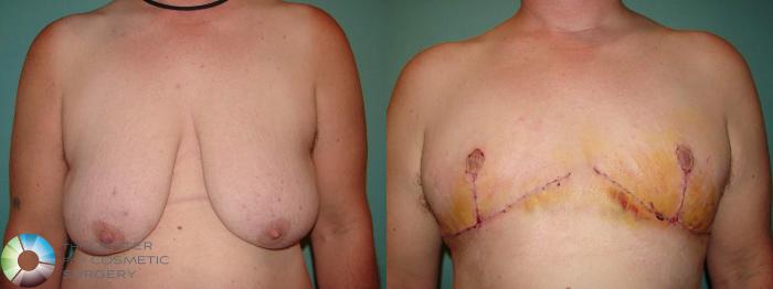 Before & After FTM Top Surgery/Chest Masculinization Case 10915 Anterior in Denver and Colorado Springs, CO
