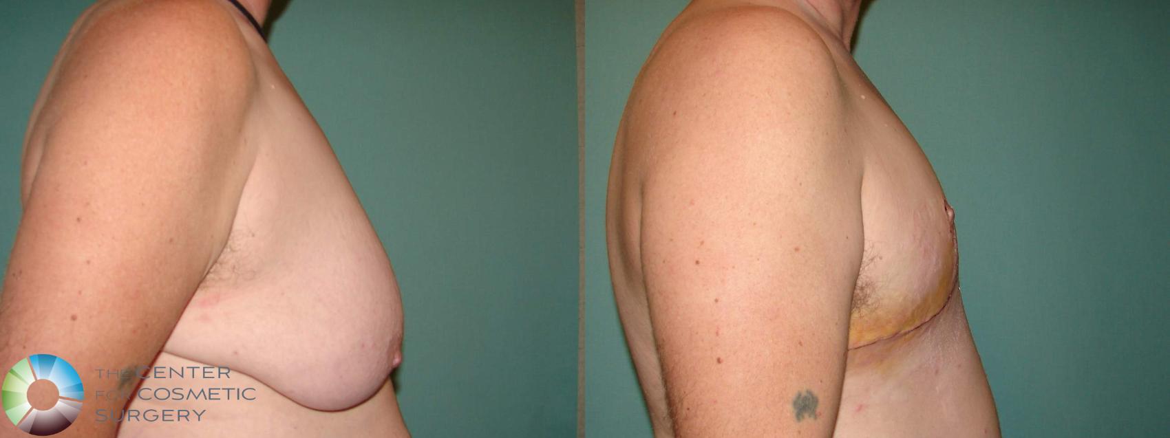 Before & After FTM Top Surgery/Chest Masculinization Case 10915 Right Side in Denver and Colorado Springs, CO